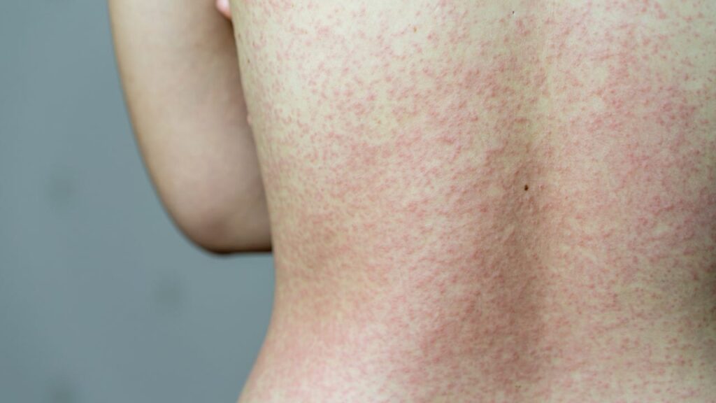 Unimed Cuiabá alerta para vacinação após casos de Sarampo confirmados em MT