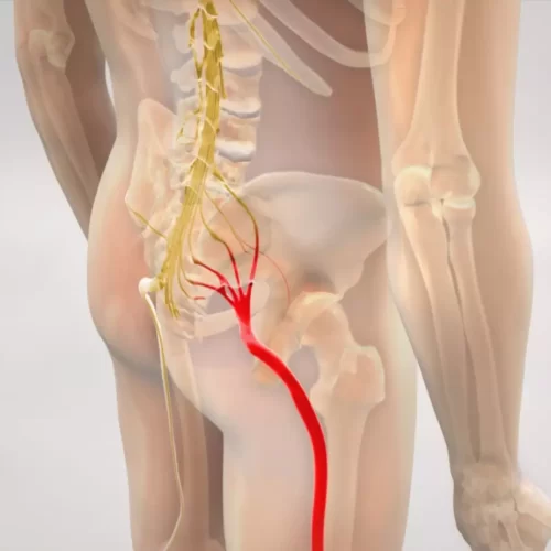 ALERTA: Dor no ciático, veja o que causa e como tratar o problema