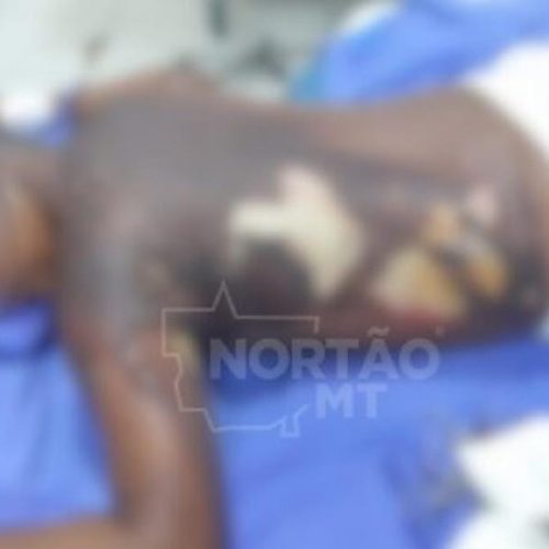 Adolescente que teve corpo queimado e foi filmado em chamas está em estado grave