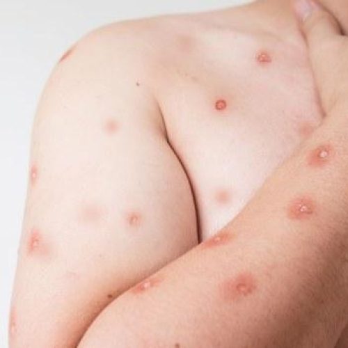 SES alerta para monitoramento de casos de Mpox em MT após avanço de variante em Rondônia