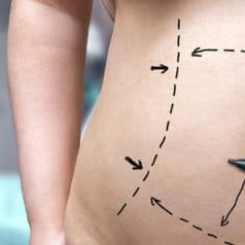 Justiça manda plano de saúde pagar cirurgia reparadora após bariátrica em Mato Grosso