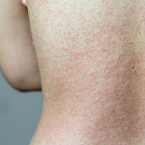 Unimed Cuiabá alerta para vacinação após casos de Sarampo confirmados em MT