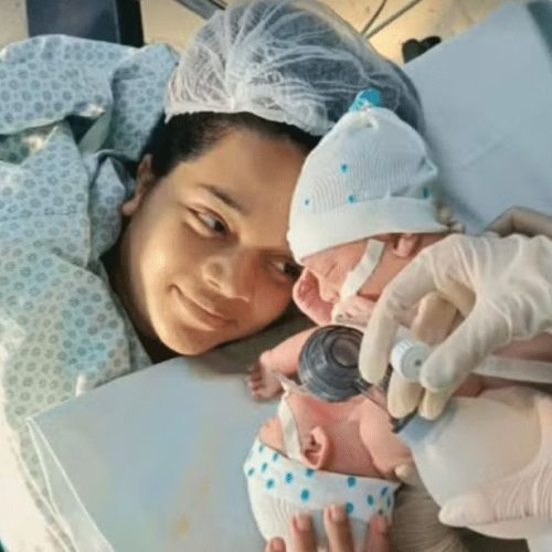 Morrem gêmeos siameses de casal mato-grossense; médicos tentaram cirurgia de separação de emergência