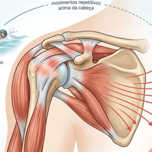 Tendinite no ombro: o que é e como preveni-la em quem pratica musculação ou esportes?